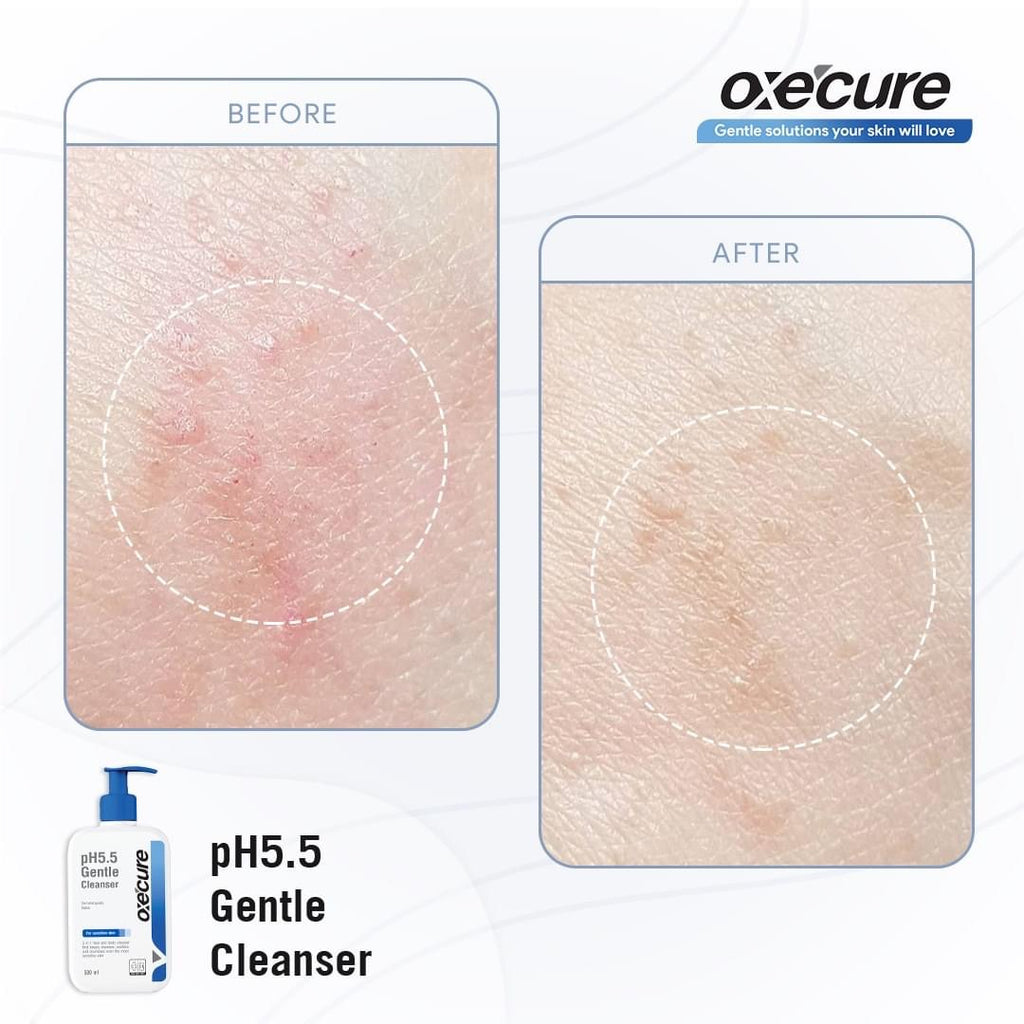 Oxecure pH 5.5 Gentle Cleanser 500ml - La Belleza AU Skin & Wellness