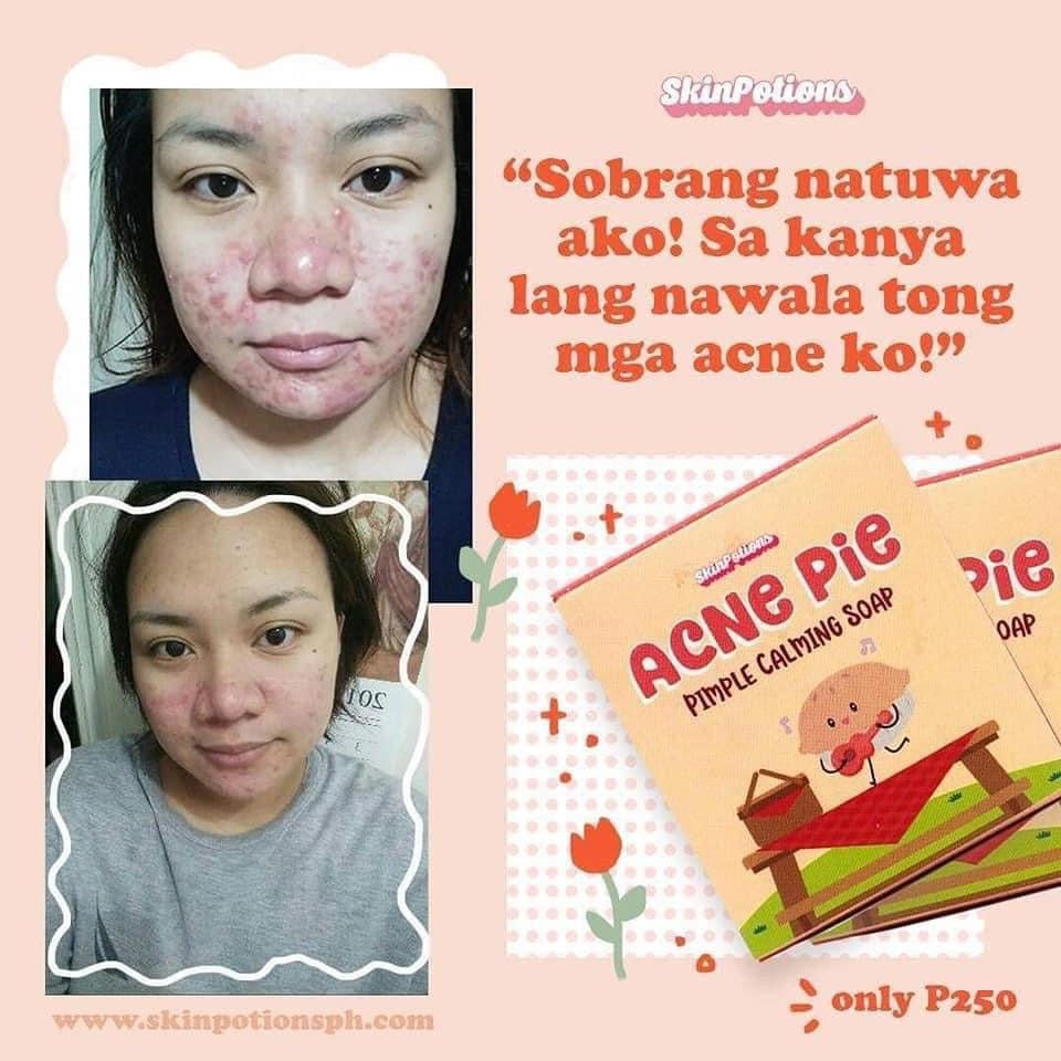 Skinpotions Acne Pie Soap (Anti-Pimple) 140g EXP Nov/2023 - La Belleza AU Skin & Wellness