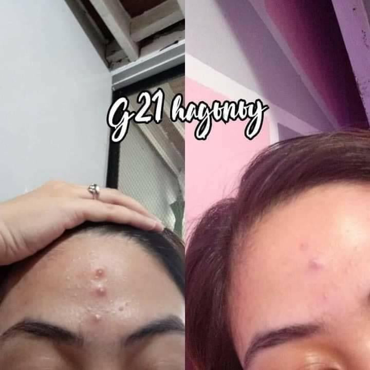 G21 Hydrocolloid Pimple Patches - La Belleza AU Skin & Wellness