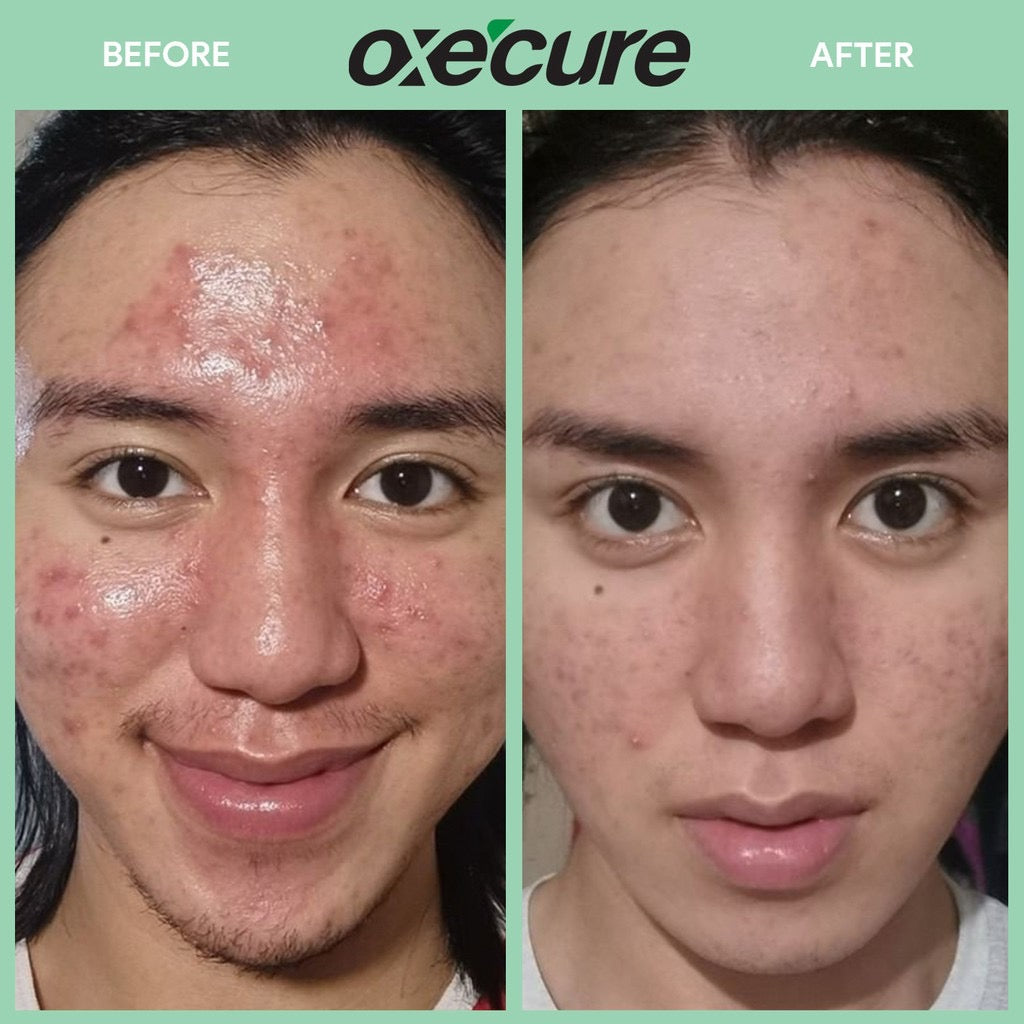 Oxecure Acne Defense Prebio Serum 20ml - La Belleza AU Skin & Wellness