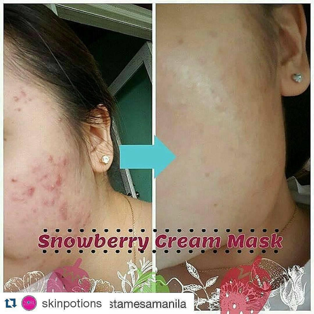 SkinPotions Snowberry Cream Mask 50g - Lightening Anti-Acne Cream (EXP 08/2023) - La Belleza AU Skin & Wellness